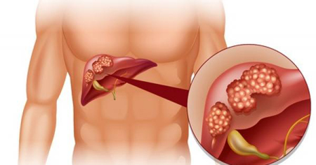 Viêm gan B là căn bệnh có khả năng giết người thầm lặng