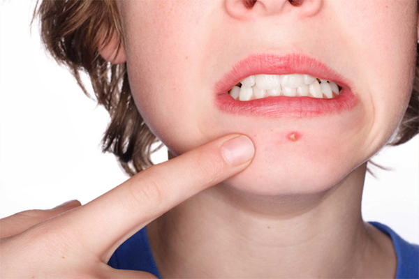 Khi gan bị nóng bạn sẽ dễ bị nổi mụn 