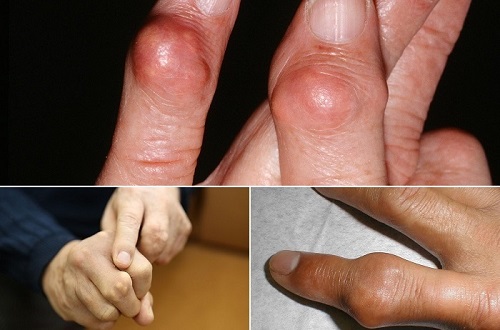 Bệnh gút là tình trạng Acid Uric trong máu tăng vượt mức