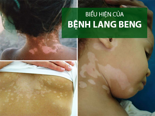 Những biểu hiện thường thấy của bệnh lang ben