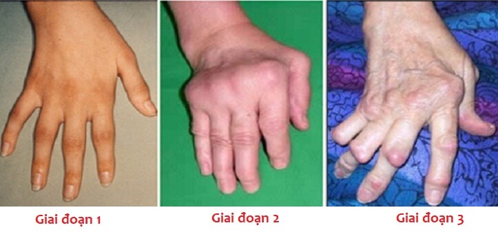Bệnh phong có thể gây biến chứng nguy hiểm nếu không điều trị kịp thời