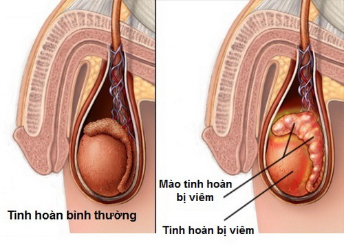Bệnh quai bị có thể gây biến chứng viêm tinh hoàn