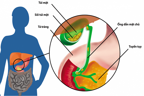 Sỏi mật là căn bệnh nguy hiểm, cần phát hiện sớm để điều trị 