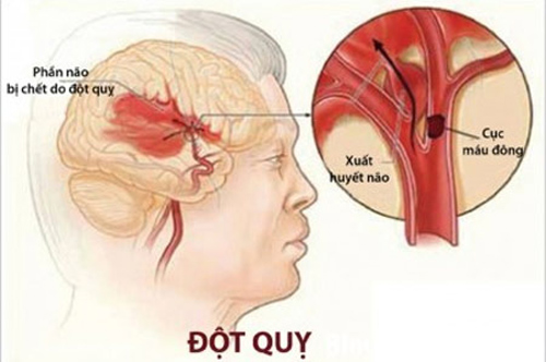 Đây là căn bệnh đến đột ngột không báo trước