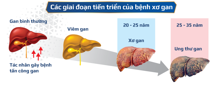 Viêm gan C không điều trị kịp thời sẽ biến chứng thành ung thư gan