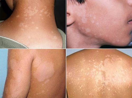 Lang beng là bệnh lý về da rất nhiều người mắc phải