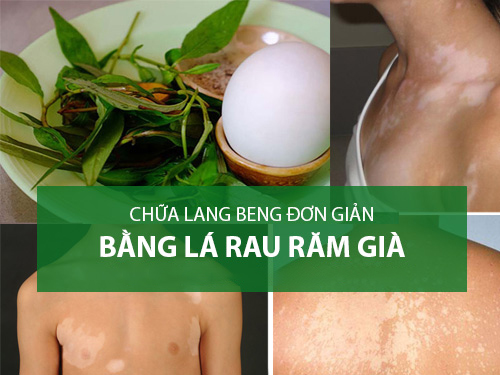 Chữa bệnh lang ben hiệu quả bằng rau răm