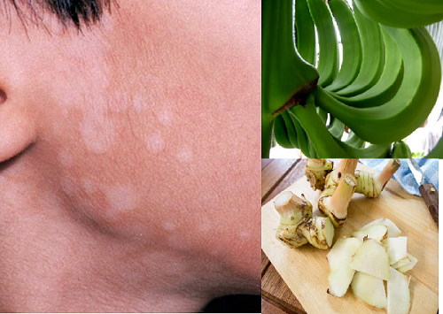 Riềng tươi giúp chữa lang beng hiệu quả