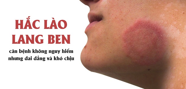 Hắc lào là căn bệnh rất phổ biến hiện tại