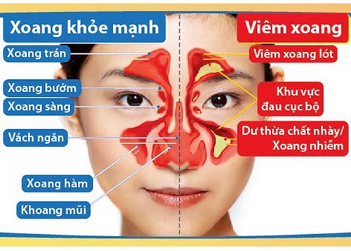 Có 2 loại viêm xoang phổ biến nhất hiện tại là cấp tính và mãn tính