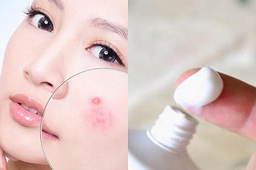 Kem đánh răng giúp trị mụn nhanh và hiệu quả