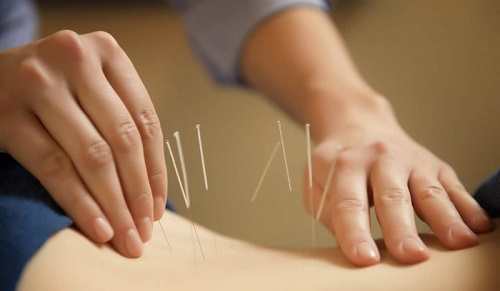Sử dụng vật lí trị liệu như châm cứu mang lại hiệu quả rất tích cực
