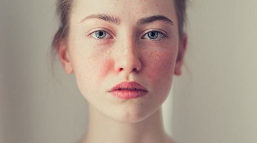 Có nhiều nguyên nhân gây dị ứng da mặt