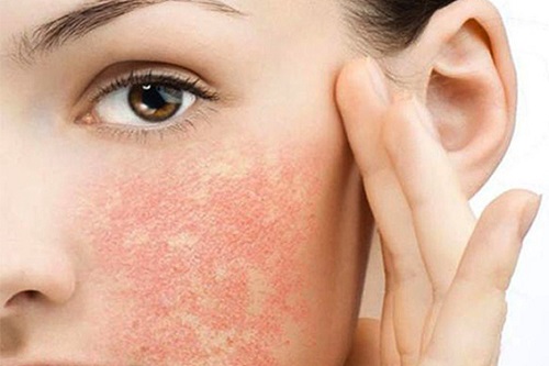 Da nổi mẩn đỏ bỏng rát là dấu hiệu dị ứng da mặt