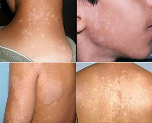 Có nhiều nguyên nhân gây bệnh lang beng ở lưng