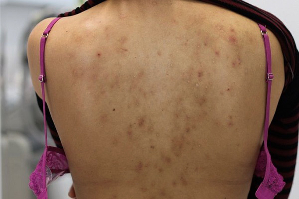 Mụn ở lưng gây đau rát và mất thẫm mỹ 