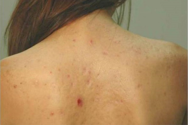 Mụn lưng nếu không được điều trị đúng cách sẽ dễ lây lan 