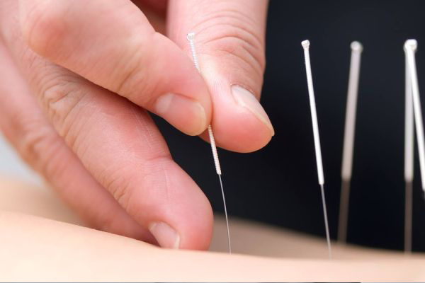 Châm cứu là phương pháp điều trị đau thần kinh tọa được nhiều người áp dụng 