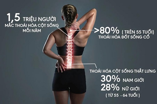 Đau vùng thắt lưng có thể là dấu hiệu của thoái hóa cột sống