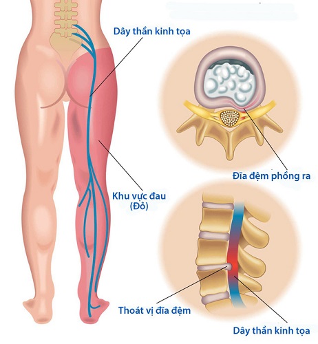 Dây thần kinh tọa bị tổn thương gây đau