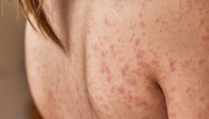 Kim Ngân Hoa Có Gì Mà Đông Y Dùng Suốt Hàng Trăm Năm?