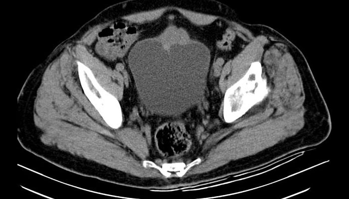 Khối u biểu mô tuyến Urachus