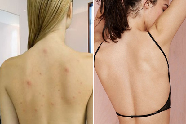 Mụn ở lưng gây mất thẫm mỹ, khiến phái đẹp không diện được những trang phục quyến rũ 