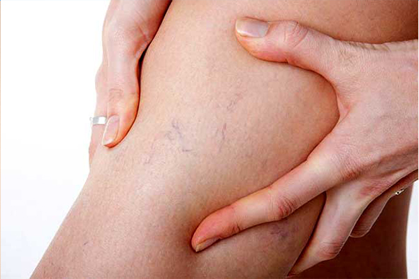 Giãn tĩnh mạch chân nếu không điều trị sớm sẽ để lại những biến chứng nguy hiểm 