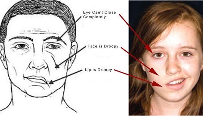 Bạch Cương Tàm Là Gì? Công Dụng Và Cách Dùng Trị Liệt Mặt, Đau Đầu, Phong Thấp