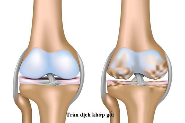 Tràn dịch khớp gối gây đau nhức và cản trở vận động 
