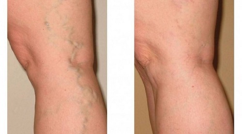 Các triệu chứng của suy giãn tĩnh mạch chân