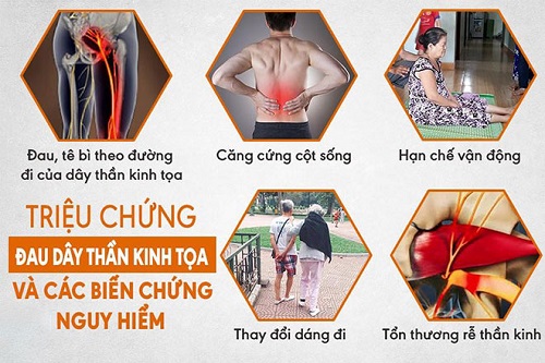 Triệu chứng đau dây thần kinh tọa thường gặp