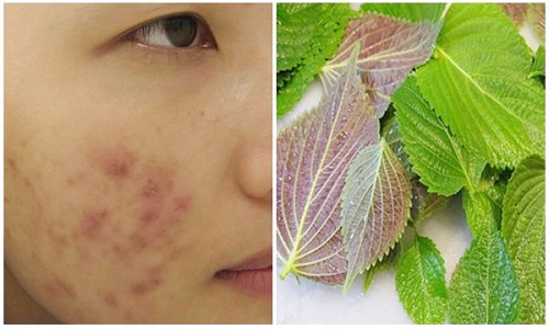 Giải Đáp Thắc Mắc: Uống Nước Lá Tía Tô Có Tác Dụng Gì? Uống nước lá tía tô có tác dụng trị mụn làm đẹp da