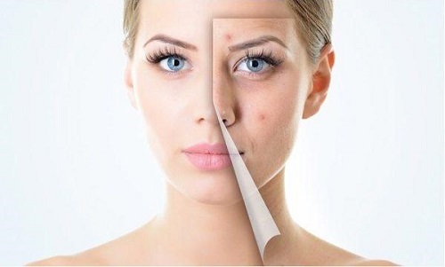 Uống Vitamin E giúp hỗ trợ trị mụn, làm mờ sẹo