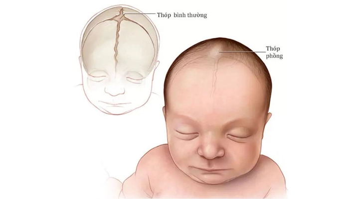 Thừa Vitamin A: Nguyên Nhân, Triệu Chứng, Tác Hại và Cách Phòng Ngừa (Cập nhật 2025)